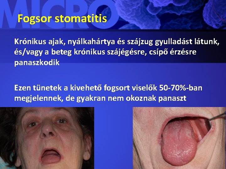 Fogsor stomatitis Krónikus ajak, nyálkahártya és szájzug gyulladást látunk, és/vagy a beteg krónikus szájégésre,