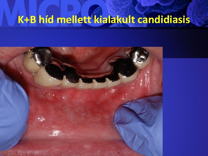 K+B híd mellett kialakult candidiasis 