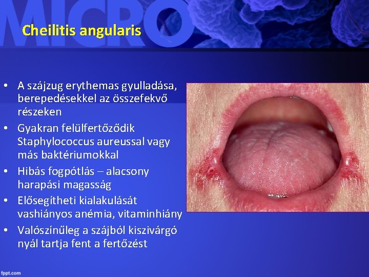 Cheilitis angularis • A szájzug erythemas gyulladása, berepedésekkel az összefekvő részeken • Gyakran felülfertőződik