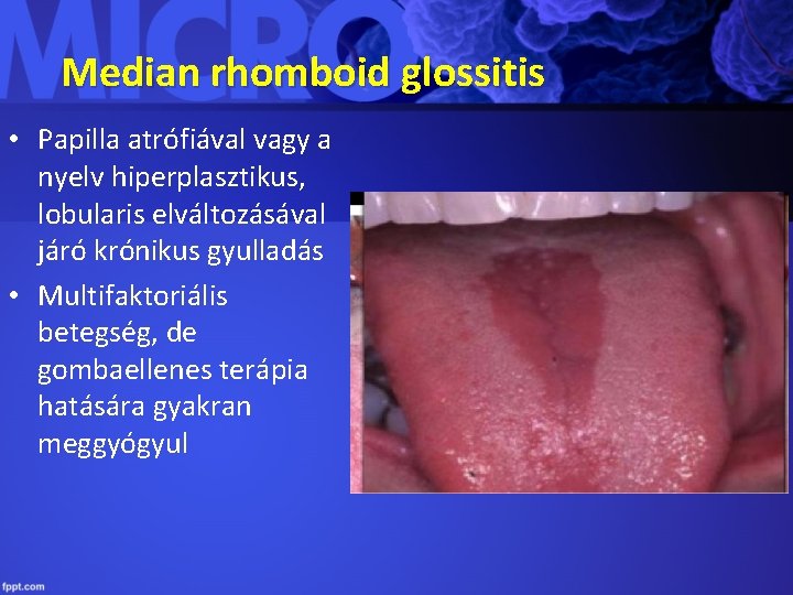 Median rhomboid glossitis • Papilla atrófiával vagy a nyelv hiperplasztikus, lobularis elváltozásával járó krónikus