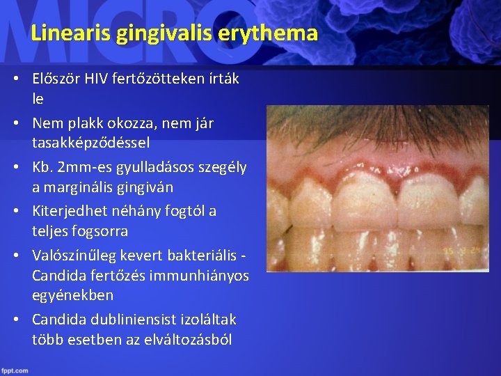 Linearis gingivalis erythema • Először HIV fertőzötteken írták le • Nem plakk okozza, nem