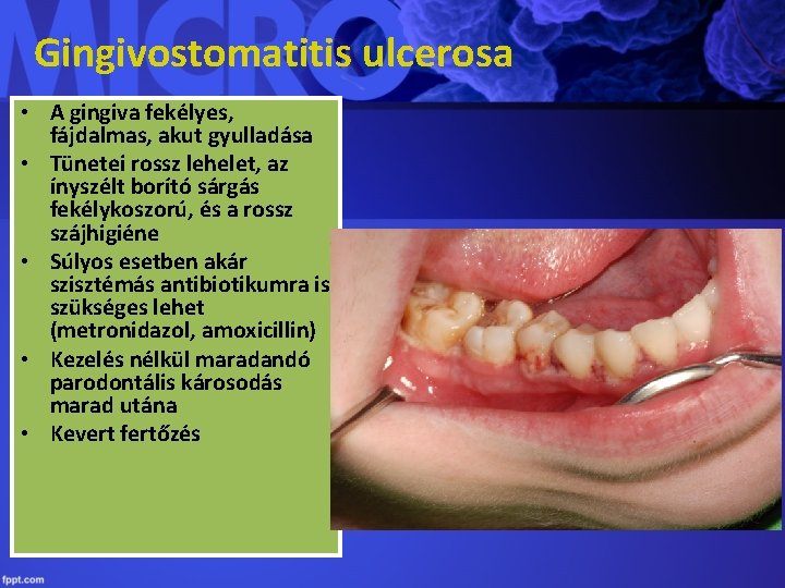 Gingivostomatitis ulcerosa • A gingiva fekélyes, fájdalmas, akut gyulladása • Tünetei rossz lehelet, az