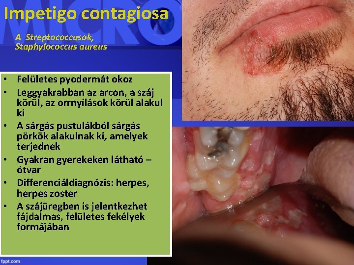 Impetigo contagiosa A Streptococcusok, Staphylococcus aureus • Felületes pyodermát okoz • Leggyakrabban az arcon,