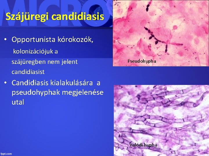 Szájüregi candidiasis • Opportunista kórokozók, kolonizációjuk a szájüregben nem jelent candidiasist Pseudohypha • Candidiasis