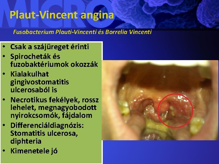 Plaut-Vincent angina Fusobacterium Plauti-Vincenti és Borrelia Vincenti • Csak a szájüreget érinti • Spirocheták