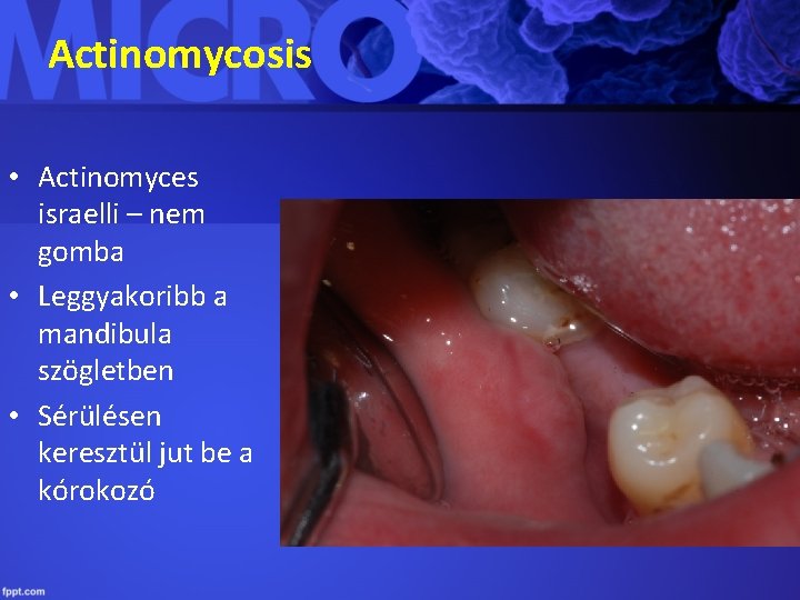 Actinomycosis • Actinomyces israelli – nem gomba • Leggyakoribb a mandibula szögletben • Sérülésen