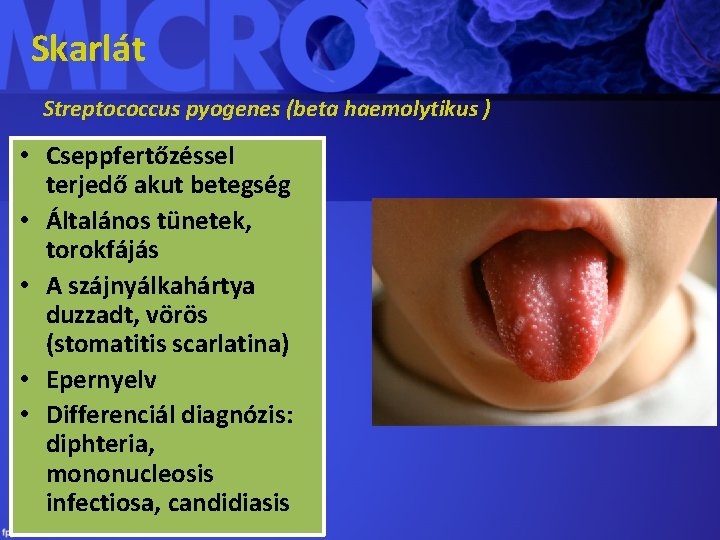 Skarlát Streptococcus pyogenes (beta haemolytikus ) • Cseppfertőzéssel terjedő akut betegség • Általános tünetek,