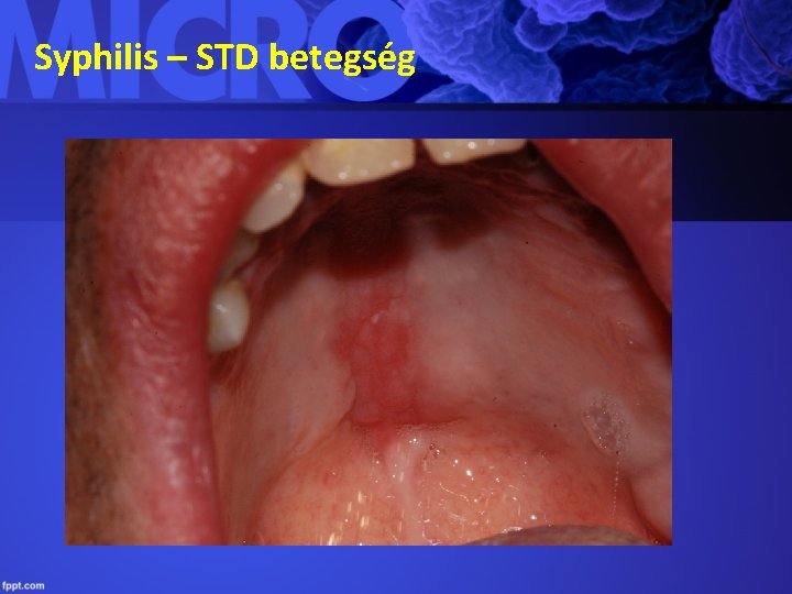 Syphilis – STD betegség 