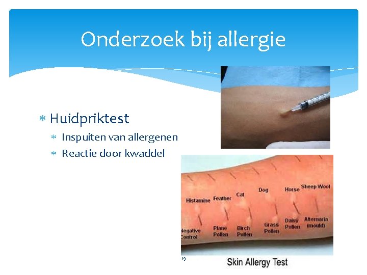 Onderzoek bij allergie Huidpriktest Inspuiten van allergenen Reactie door kwaddel 19 