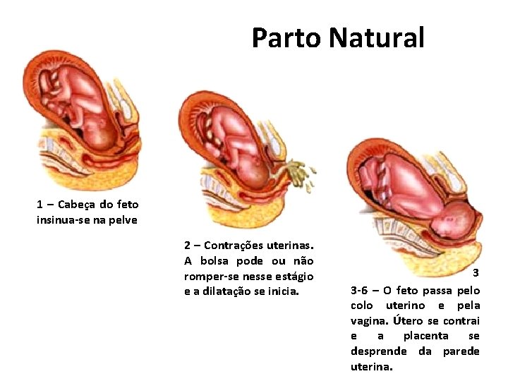 Parto Natural 1 – Cabeça do feto insinua-se na pelve 2 – Contrações uterinas.