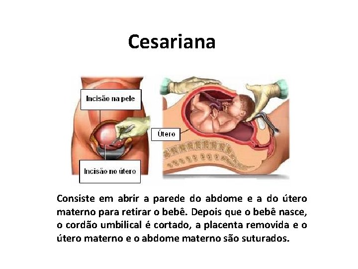 Cesariana Consiste em abrir a parede do abdome e a do útero materno para