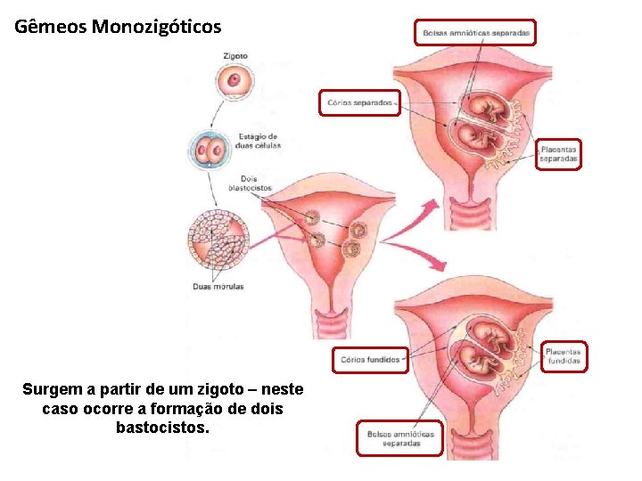 Gêmeos Monozigóticos Surgem a partir de um zigoto – neste caso ocorre a formação