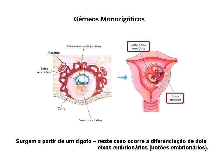 Gêmeos Monozigóticos Surgem a partir de um zigoto – neste caso ocorre a diferenciação