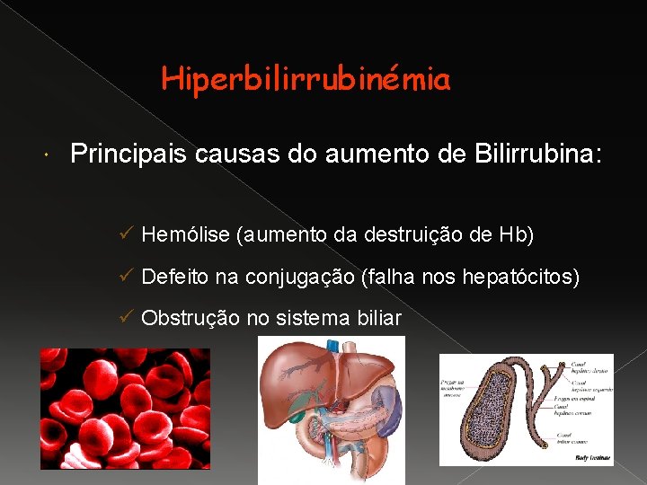 Hiperbilirrubinémia Principais causas do aumento de Bilirrubina: ü Hemólise (aumento da destruição de Hb)