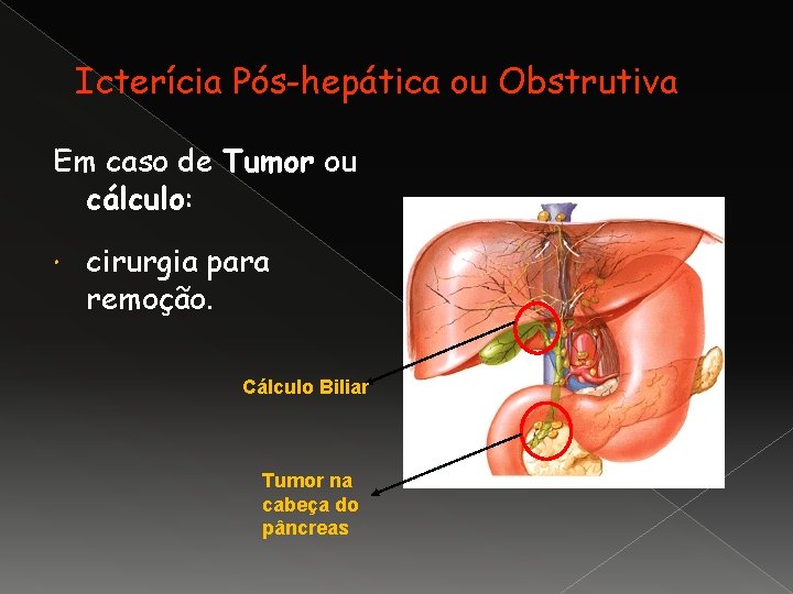 Icterícia Pós-hepática ou Obstrutiva Em caso de Tumor ou cálculo: cirurgia para remoção. Cálculo