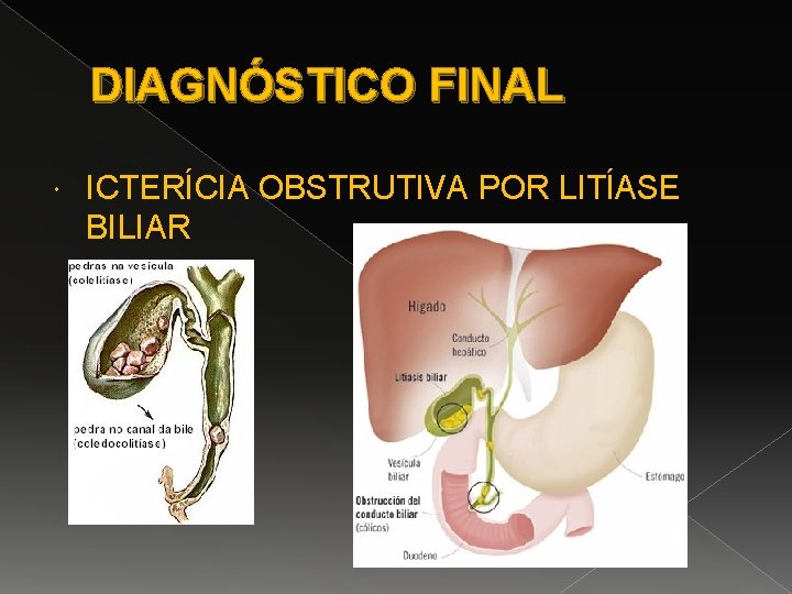 DIAGNÓSTICO FINAL ICTERÍCIA OBSTRUTIVA POR LITÍASE BILIAR 