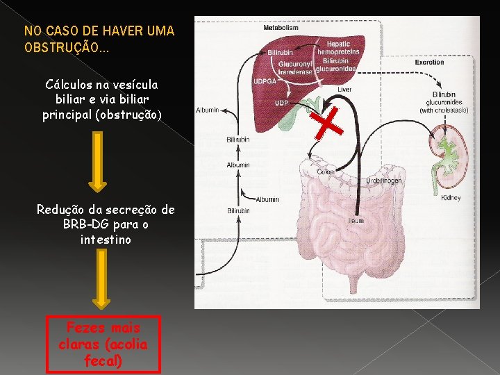 NO CASO DE HAVER UMA OBSTRUÇÃO… Cálculos na vesícula biliar e via biliar principal