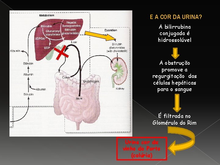 E A COR DA URINA? A bilirrubina conjugada é hidrossolúvel A obstrução promove a