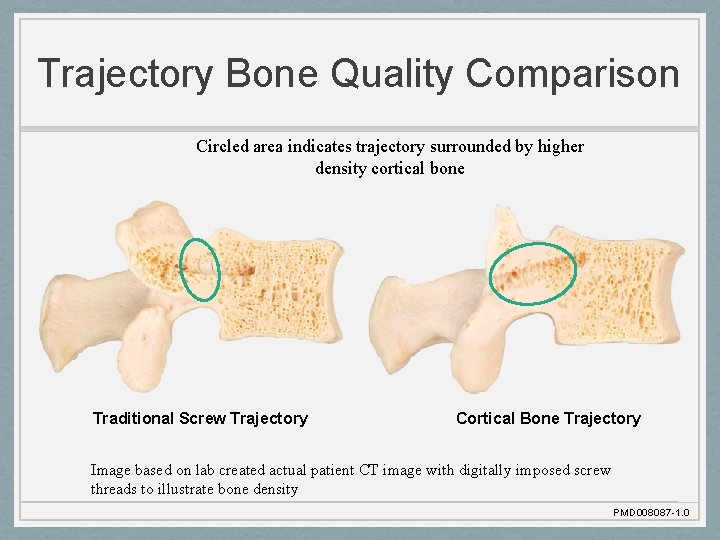 Trajectory Bone Quality Comparison Circled area indicates trajectory surrounded by higher density cortical bone