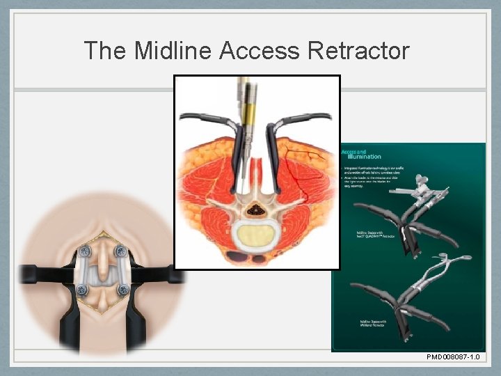 The Midline Access Retractor PMD 008087 -1. 0 