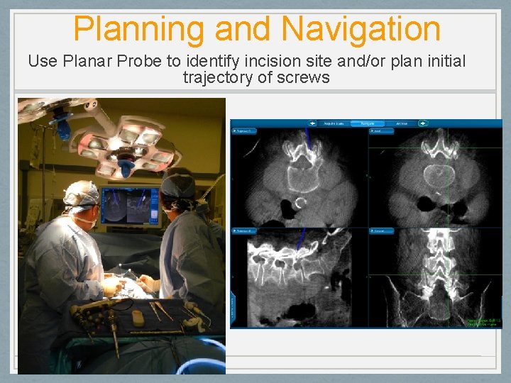 Planning and Navigation Use Planar Probe to identify incision site and/or plan initial trajectory