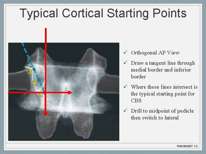 Typical Cortical Starting Points ü Orthogonal AP View ü Draw a tangent line through