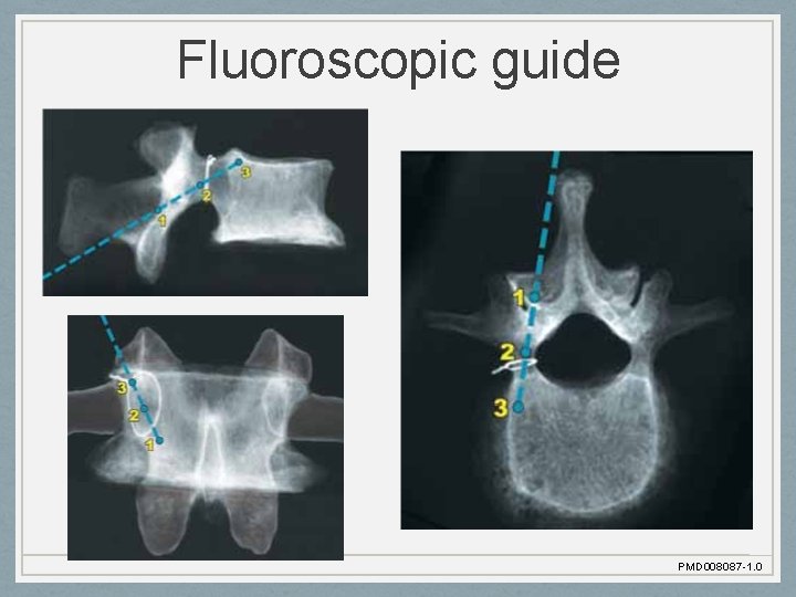 Fluoroscopic guide PMD 008087 -1. 0 