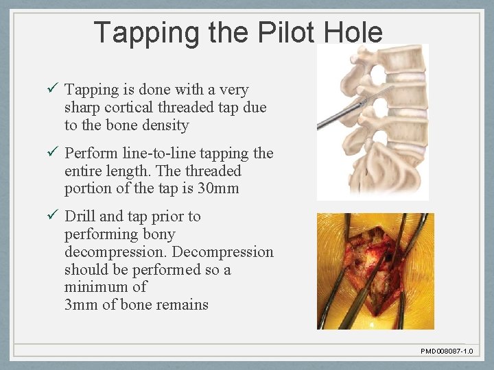 Tapping the Pilot Hole ü Tapping is done with a very sharp cortical threaded