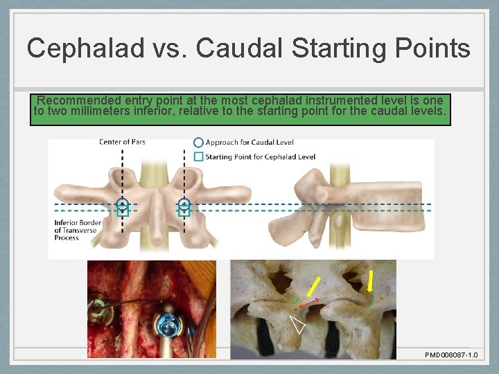 Cephalad vs. Caudal Starting Points Recommended entry point at the most cephalad instrumented level