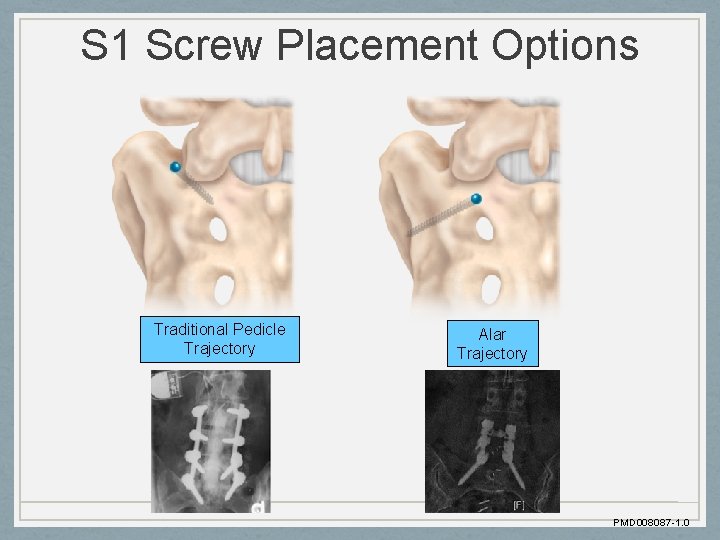 S 1 Screw Placement Options Traditional Pedicle Trajectory Alar Trajectory PMD 008087 -1. 0