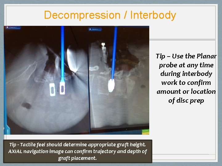 Decompression / Interbody Tip – Use the Planar probe at any time during interbody