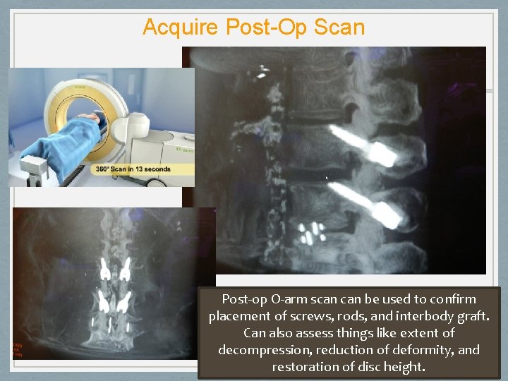 Acquire Post-Op Scan Post-op O-arm scan be used to confirm placement of screws, rods,