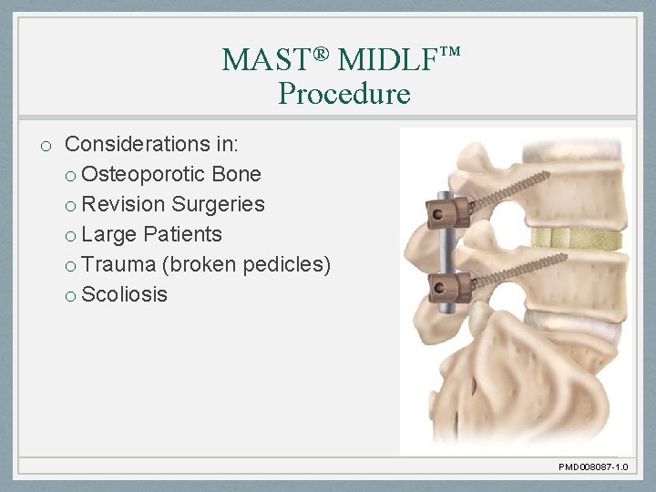 MAST® MIDLF™ Procedure o Considerations in: o Osteoporotic Bone o Revision Surgeries o Large
