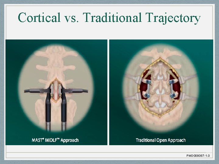 Cortical vs. Traditional Trajectory PMD 008087 -1. 0 