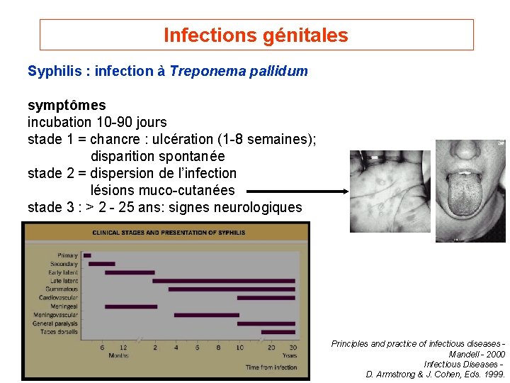 Infections génitales Syphilis : infection à Treponema pallidum symptômes incubation 10 -90 jours stade
