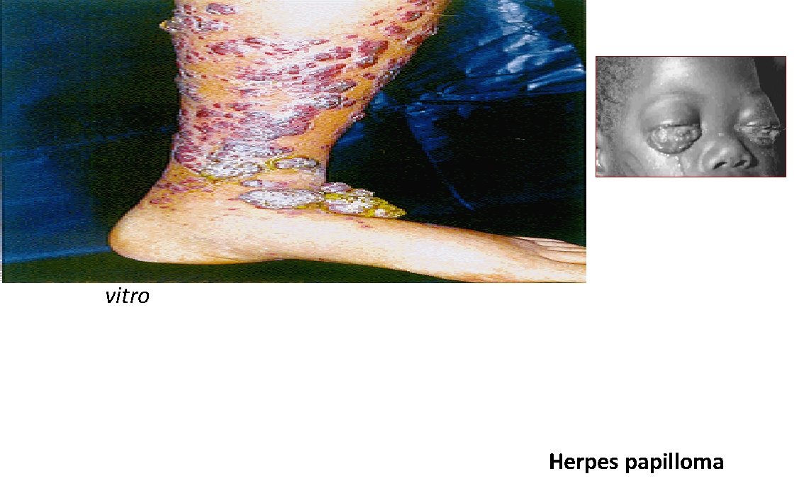 Herpes Viruses • Epstein-Barr Virus 1. Burkitt’s Lymphoma 2. Nasopharyngeal cancer 3. Infectious mononucleosis