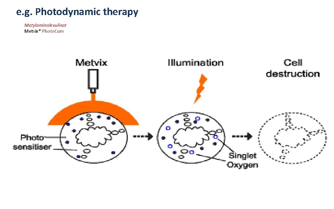 e. g. Photodynamic therapy Metylaminolevulinat Metvix® Photo. Cure 