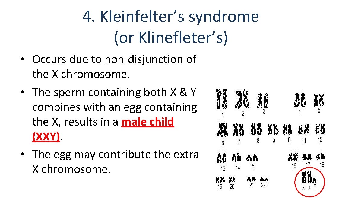 4. Kleinfelter’s syndrome (or Klinefleter’s) • Occurs due to non-disjunction of the X chromosome.