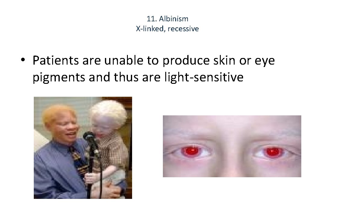 11. Albinism X-linked, recessive • Patients are unable to produce skin or eye pigments