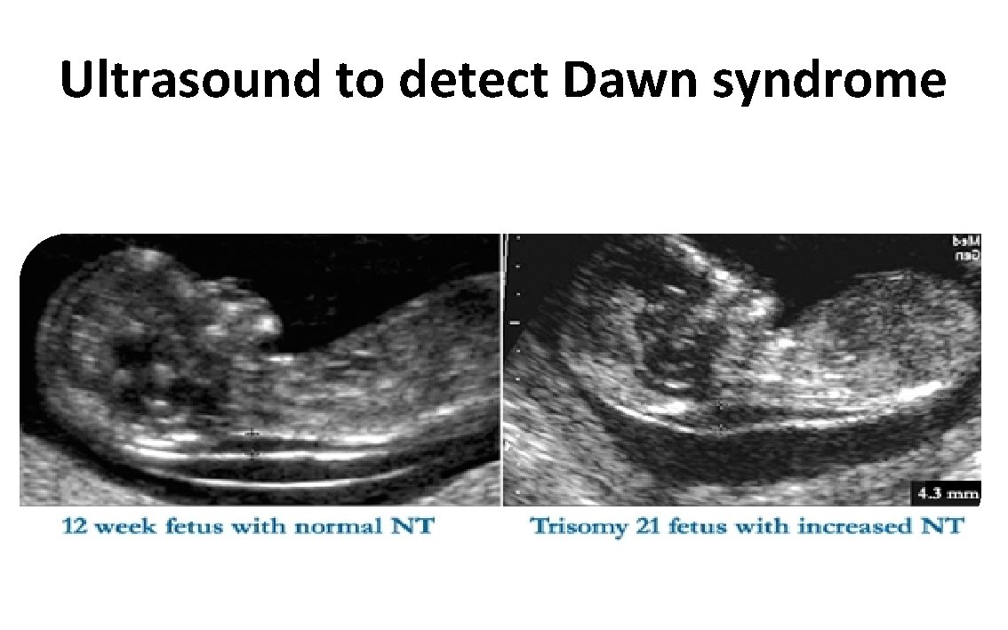 Ultrasound to detect Dawn syndrome 
