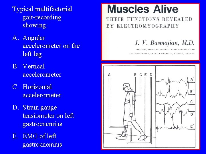 Typical multifactorial gait-recording showing: A. Angular accelerometer on the left leg B. Vertical accelerometer