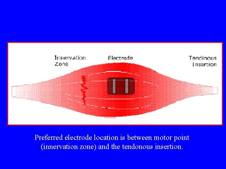 Preferred electrode location is between motor point (innervation zone) and the tendonous insertion. 