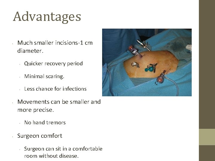Advantages • • Much smaller incisions-1 cm diameter. • Quicker recovery period • Minimal