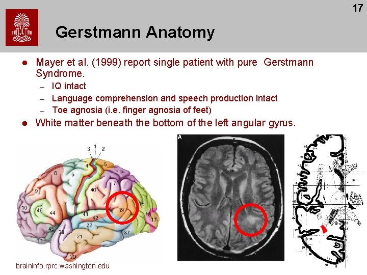 17 Gerstmann Anatomy l Mayer et al. (1999) report single patient with pure Gerstmann