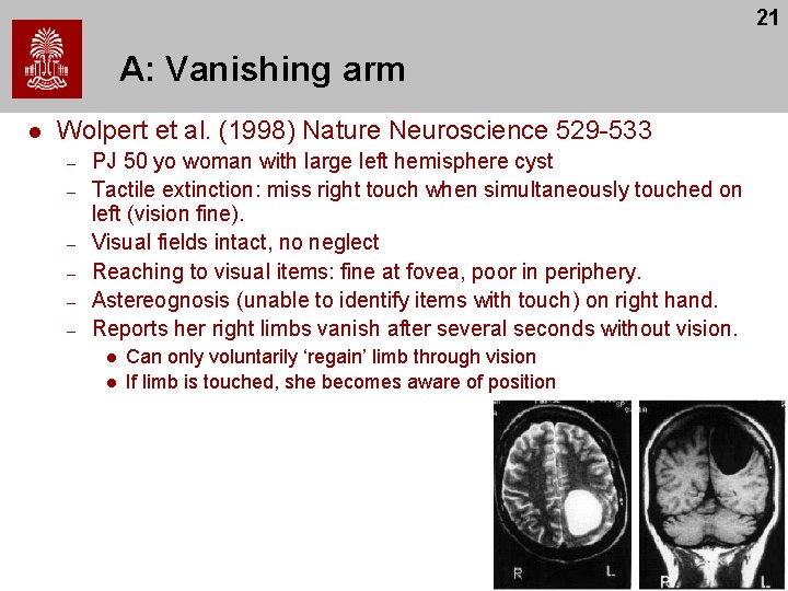 21 A: Vanishing arm l Wolpert et al. (1998) Nature Neuroscience 529 -533 –