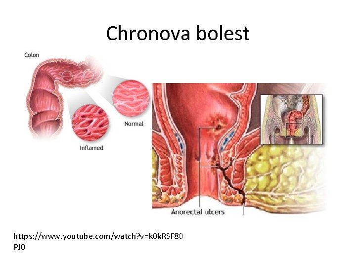 Chronova bolest https: //www. youtube. com/watch? v=k 0 k. RSF 80 PJ 0 