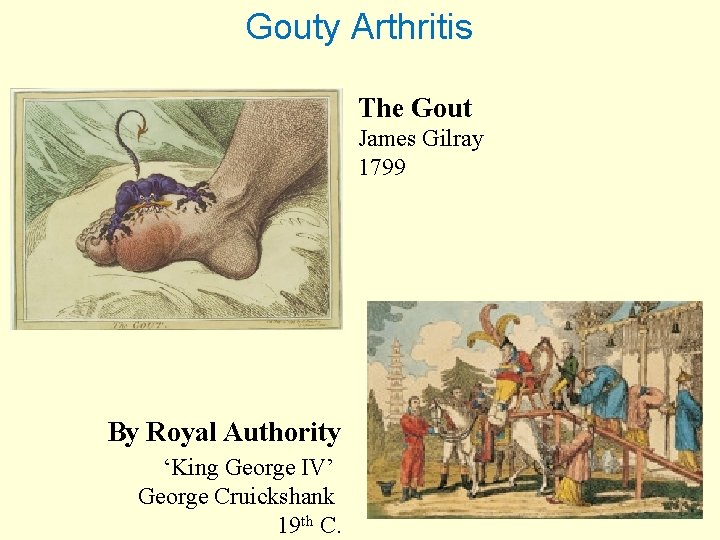 Gouty Arthritis The Gout James Gilray 1799 By Royal Authority ‘King George IV’ George
