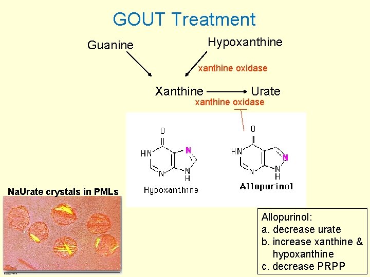 GOUT Treatment Hypoxanthine Guanine xanthine oxidase Xanthine Urate xanthine oxidase Na. Urate crystals in