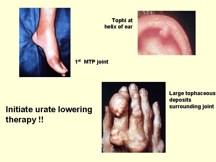 Tophi at helix of ear 1 st MTP joint Initiate urate lowering therapy !!