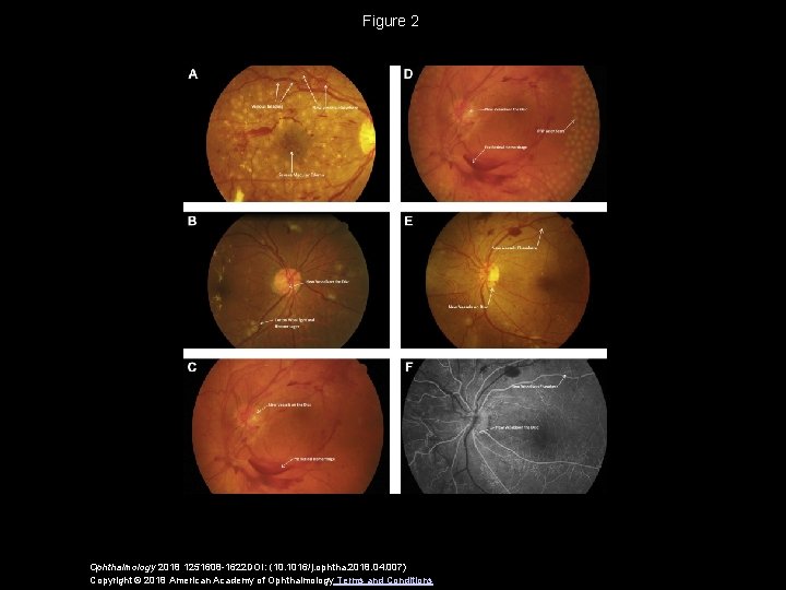 Figure 2 Ophthalmology 2018 1251608 -1622 DOI: (10. 1016/j. ophtha. 2018. 04. 007) Copyright
